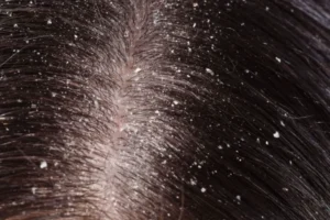 Hair tonic untuk rambut ketombe