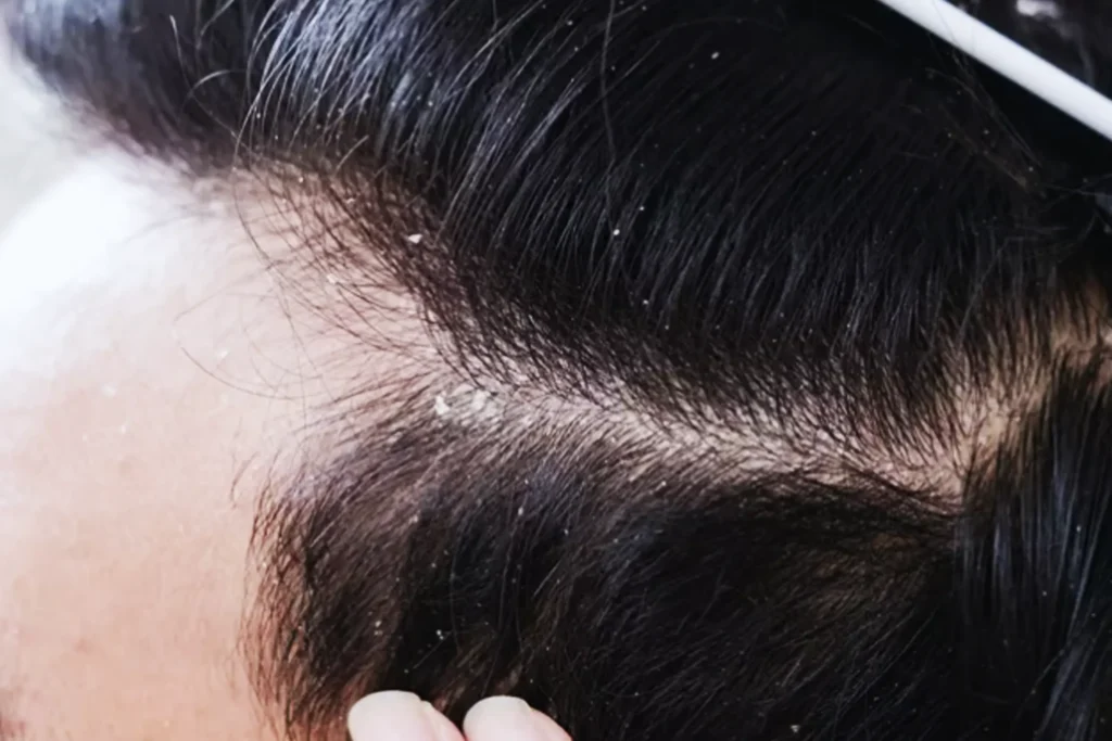 Perawatan Rambut Berketombe