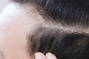 Perawatan rambut berketombe