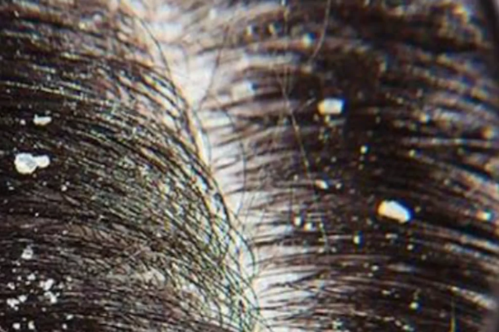 Shampo Anti Ketombe Paling Ampuh