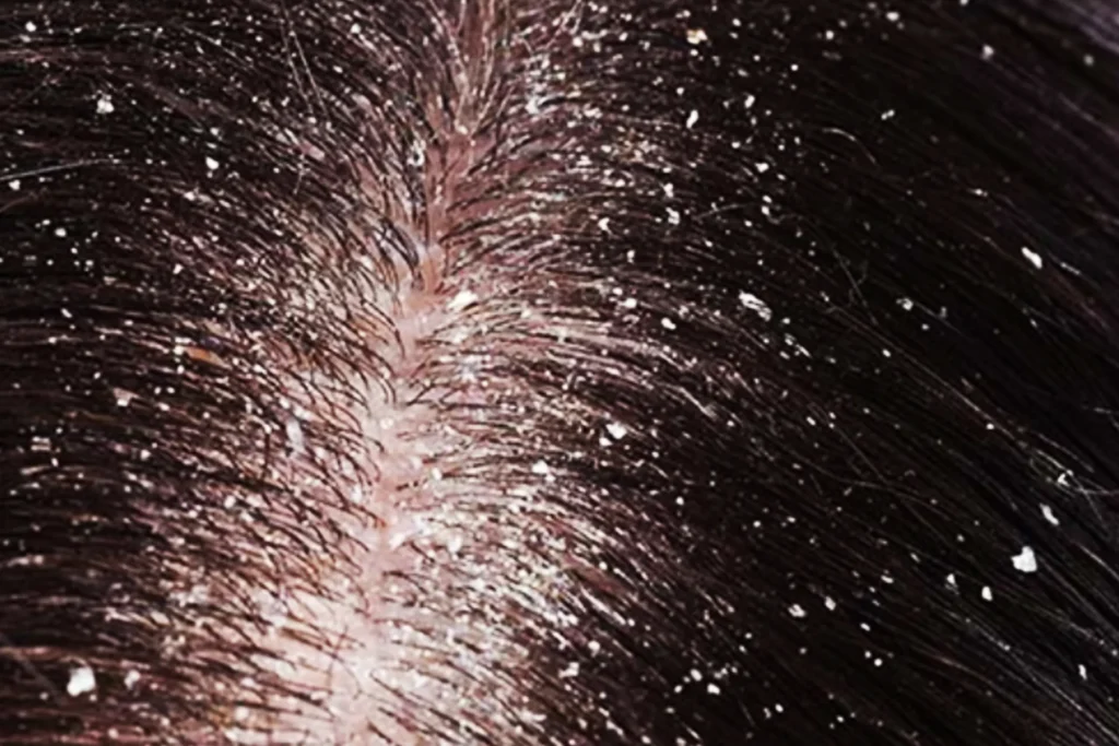 Shampo Anti Ketombe dan Gatal