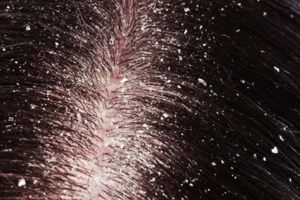 Shampo Anti Ketombe dan Gatal