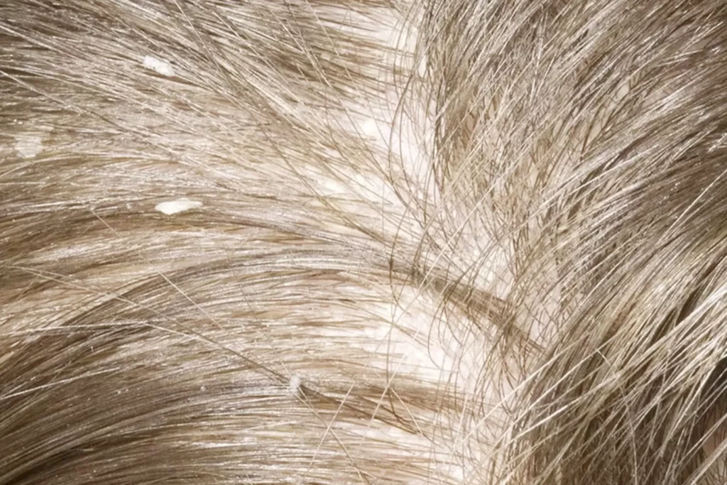 Shampo antik ketombe non sls