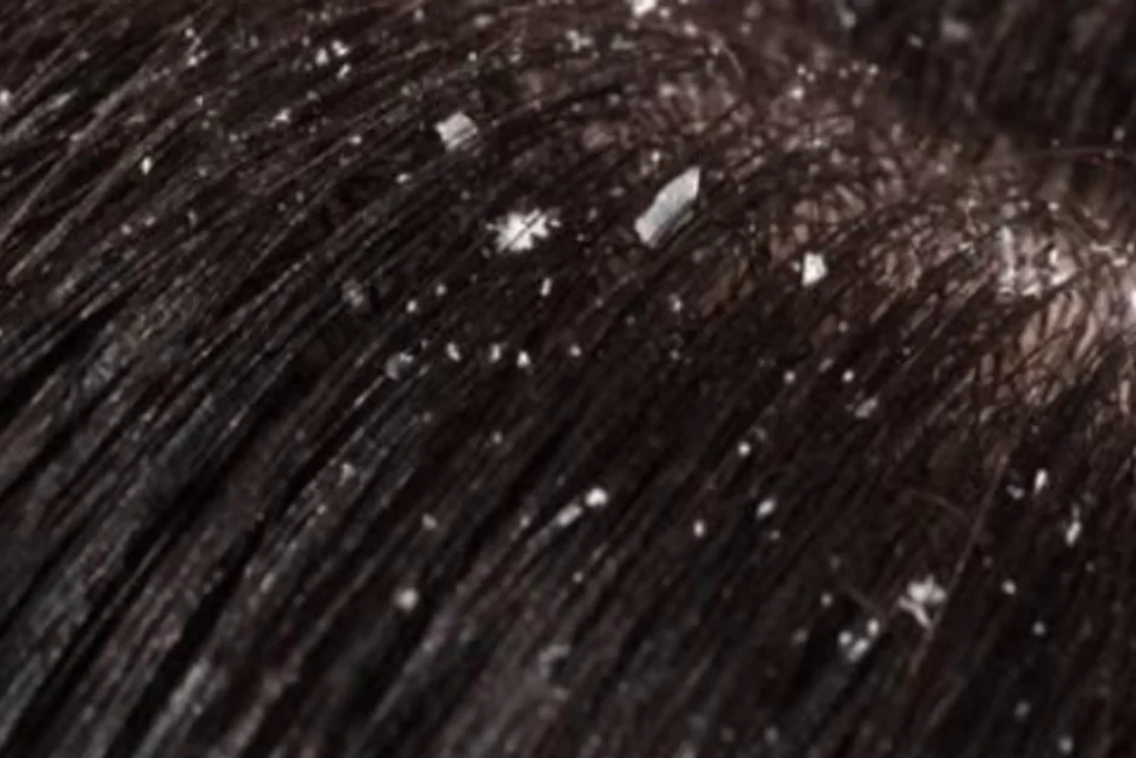 Shampo untuk Ketombe