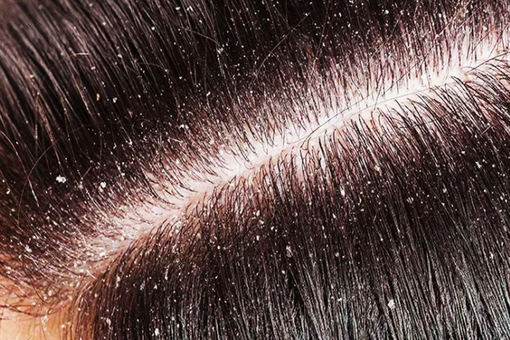 Shampo untuk Rambut Rontok