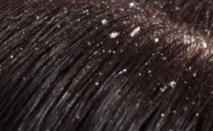 Hair Tonic Reactive untuk Mengatasi Ketombe