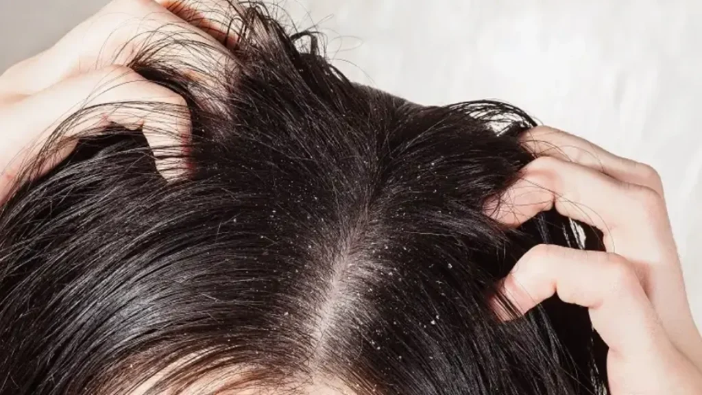 Shampo untuk ketombe dan rambut lepek